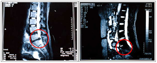 MRIフィルム｜腰痛治療