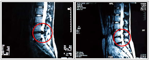 MRIフィルム｜腰痛治療