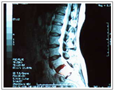 MRIフィルム｜腰痛治療